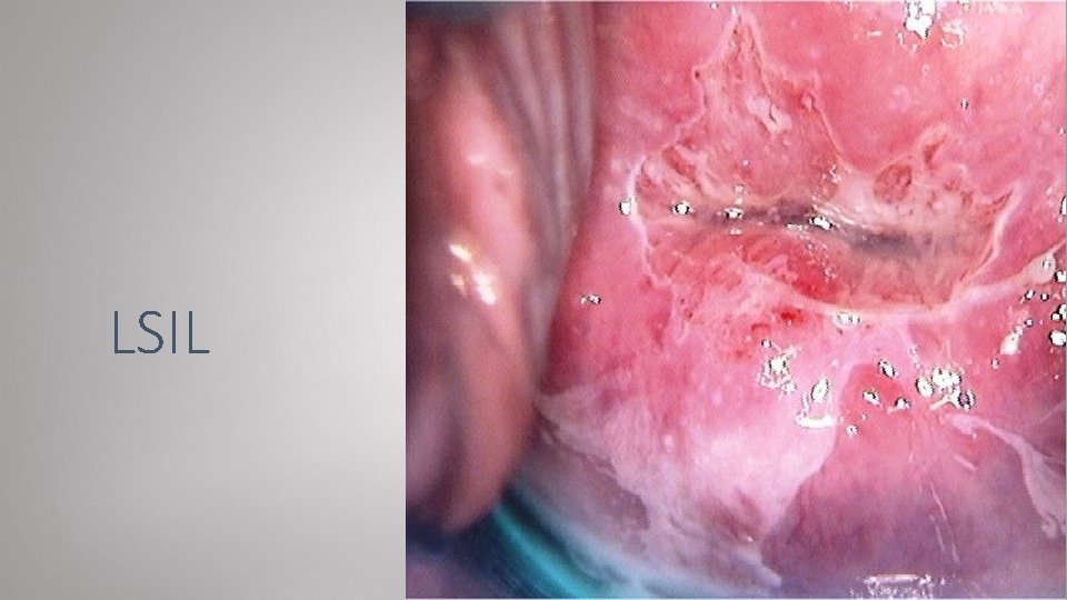 LSIL 