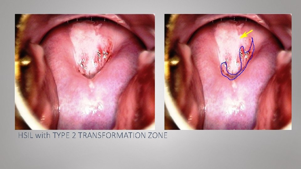HSIL with TYPE 2 TRANSFORMATION ZONE 
