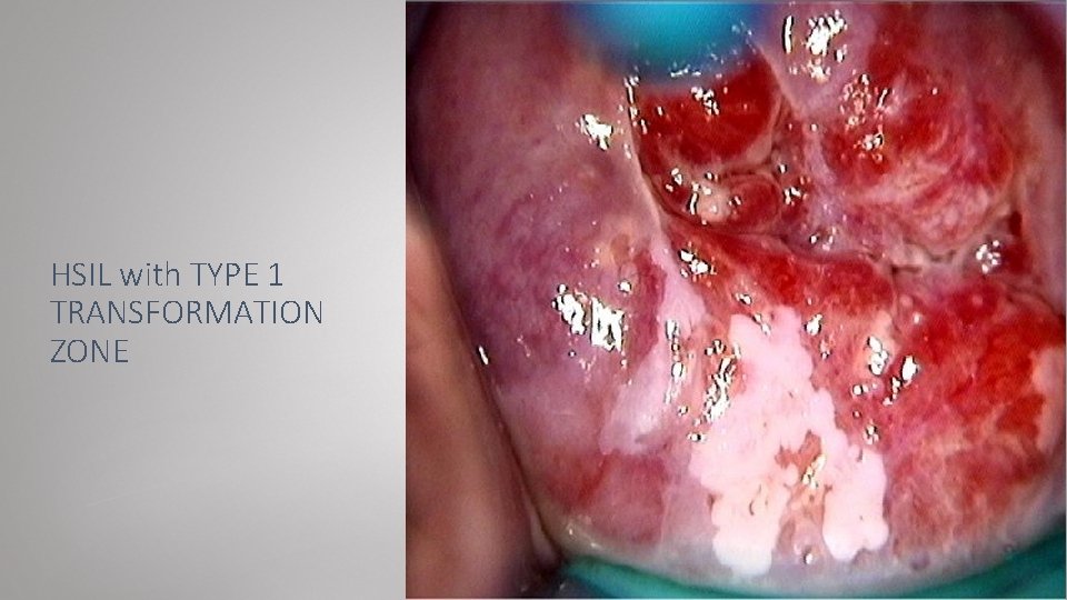 HSIL with TYPE 1 TRANSFORMATION ZONE 