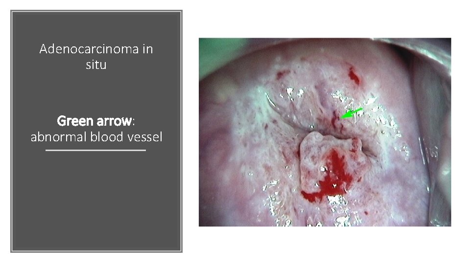 Adenocarcinoma in situ Green arrow: abnormal blood vessel 
