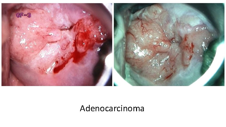 Adenocarcinoma 