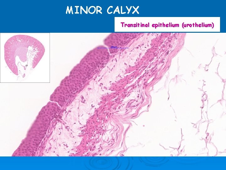 MINOR CALYX Transitinal epithelium (urothelium) 