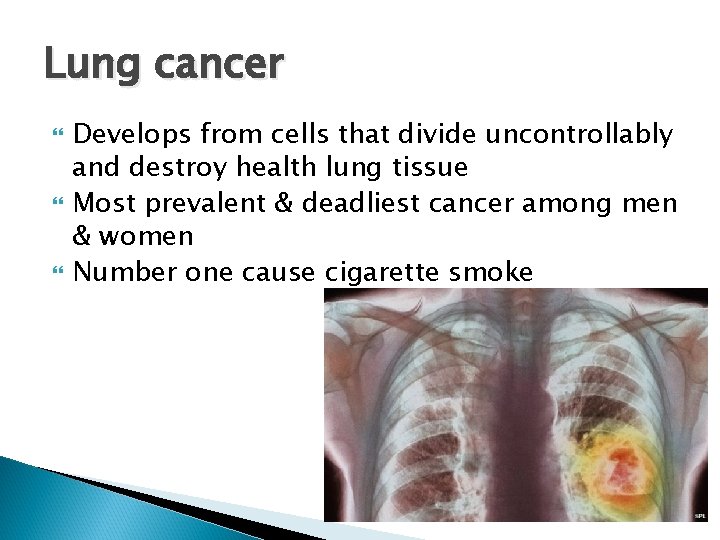 Lung cancer Develops from cells that divide uncontrollably and destroy health lung tissue Most