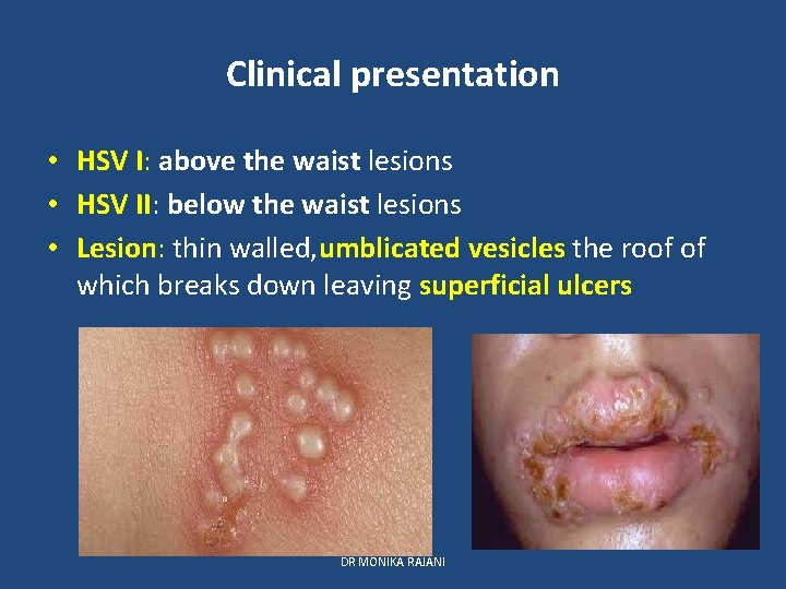 Clinical presentation • HSV I: above the waist lesions • HSV II: below the