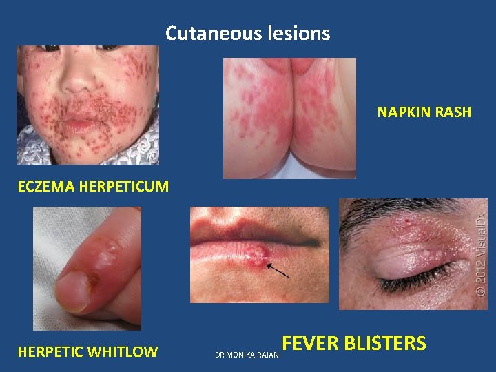 Cutaneous lesions NAPKIN RASH ECZEMA HERPETICUM HERPETIC WHITLOW DR MONIKA RAJANI FEVER BLISTERS 