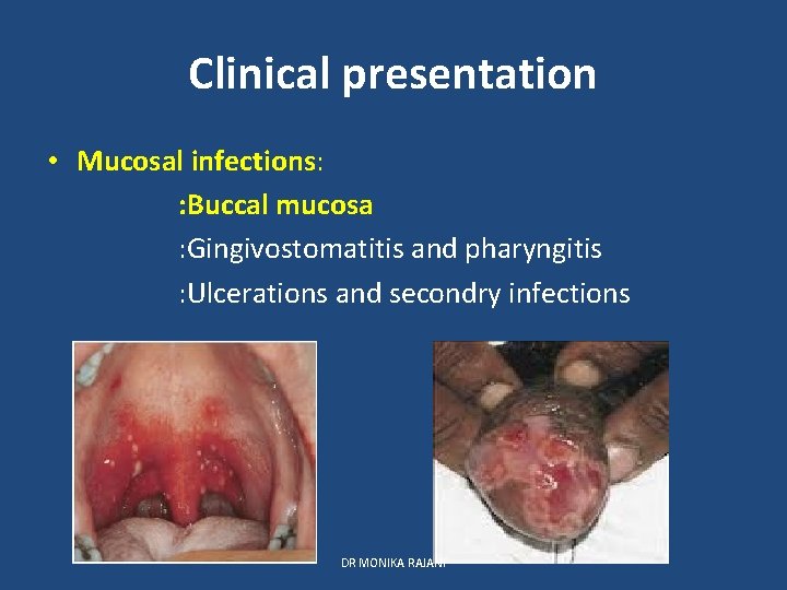Clinical presentation • Mucosal infections: : Buccal mucosa : Gingivostomatitis and pharyngitis : Ulcerations