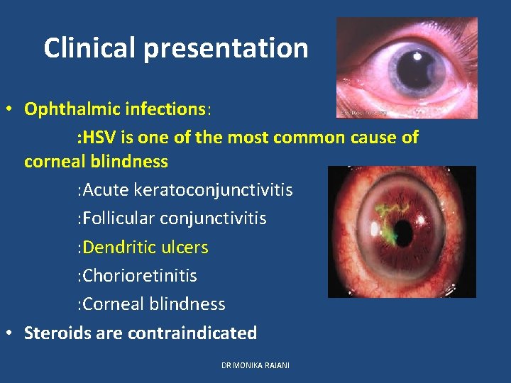 Clinical presentation • Ophthalmic infections: : HSV is one of the most common cause
