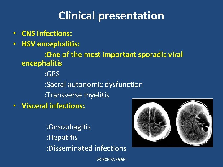 Clinical presentation • CNS infections: • HSV encephalitis: : One of the most important