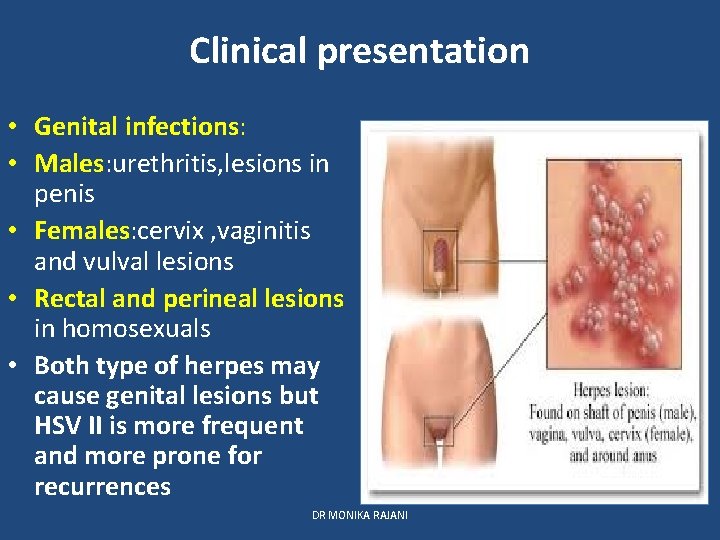 Clinical presentation • Genital infections: • Males: urethritis, lesions in penis • Females: cervix