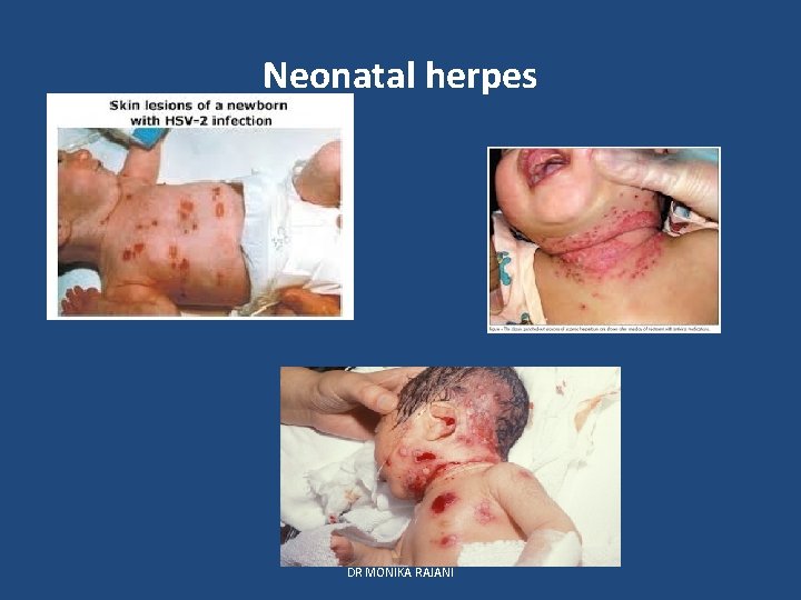 Neonatal herpes DR MONIKA RAJANI 