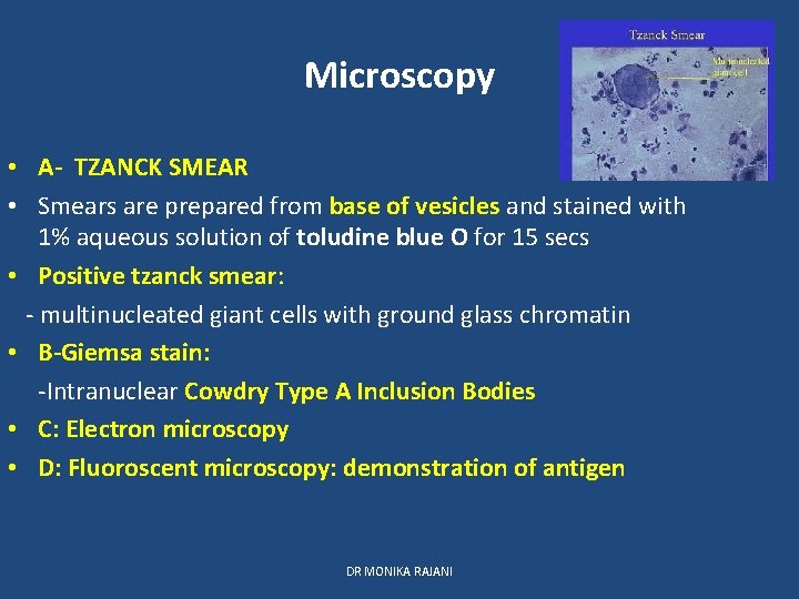 Microscopy • A- TZANCK SMEAR • Smears are prepared from base of vesicles and
