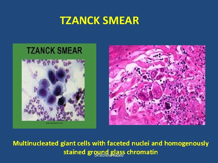 TZANCK SMEAR Multinucleated giant cells with faceted nuclei and homogenously stained ground glass chromatin