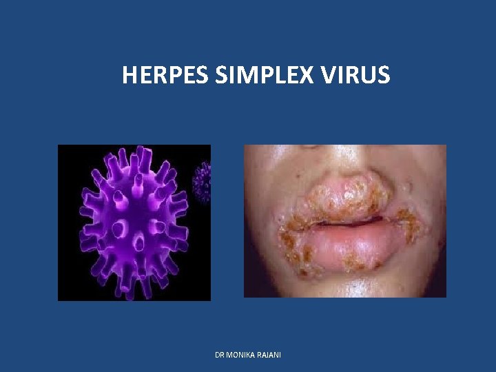 HERPES SIMPLEX VIRUS DR MONIKA RAJANI 