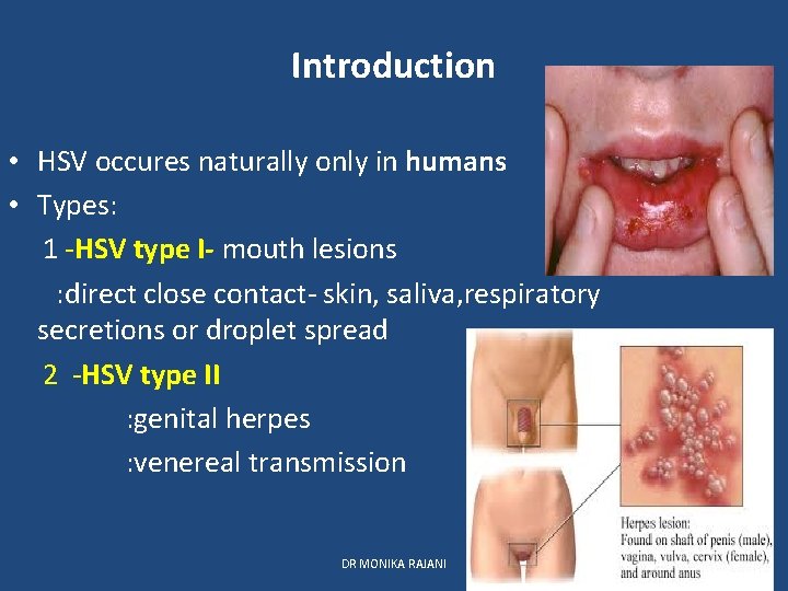 Introduction • HSV occures naturally only in humans • Types: 1 -HSV type I-
