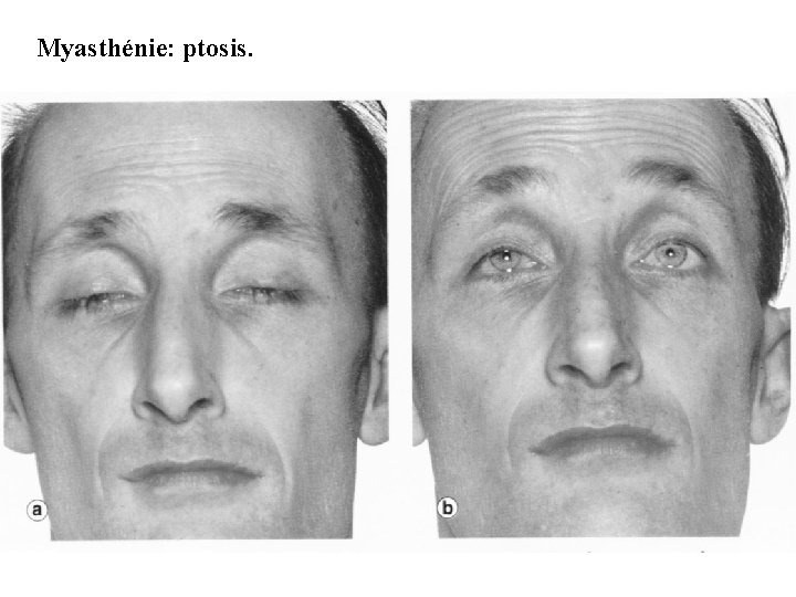 Myasthénie: ptosis. 