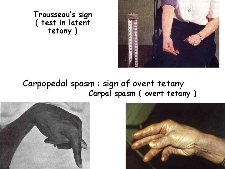 Trousseau’s sign ( test in latent tetany ) Carpopedal spasm : sign of overt