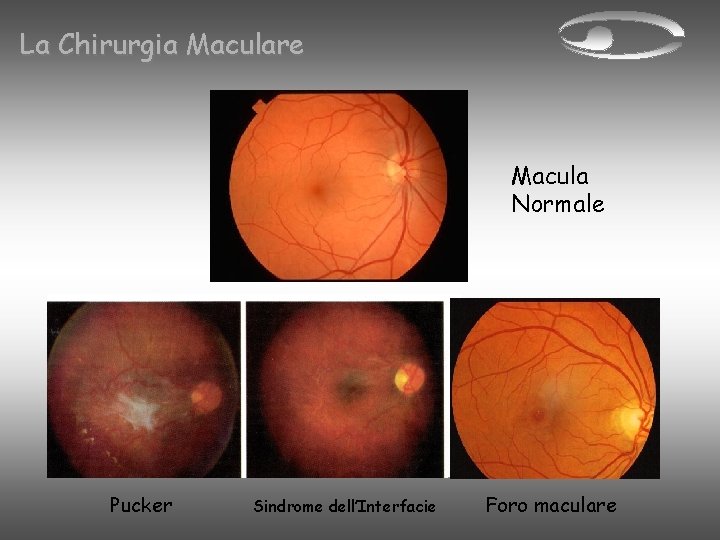 La Chirurgia Maculare Macula Normale Pucker Sindrome dell’Interfacie Foro maculare 