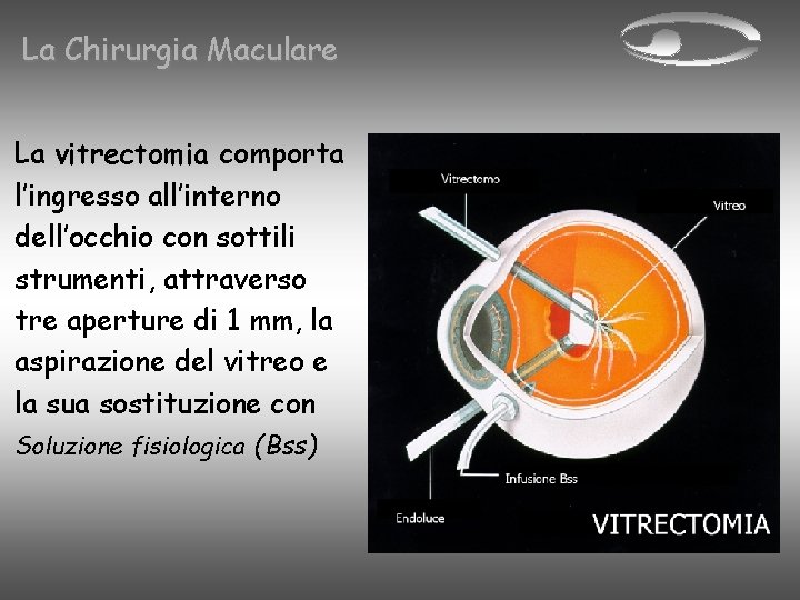 La Chirurgia Maculare La vitrectomia comporta l’ingresso all’interno dell’occhio con sottili strumenti, attraverso tre