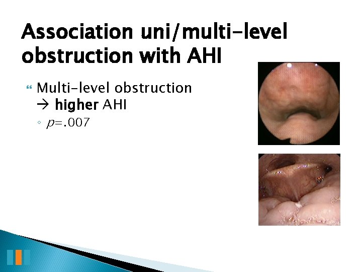 Association uni/multi-level obstruction with AHI Multi-level obstruction higher AHI ◦ p=. 007 