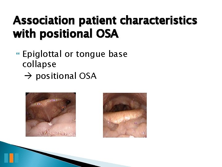 Association patient characteristics with positional OSA Epiglottal or tongue base collapse positional OSA 
