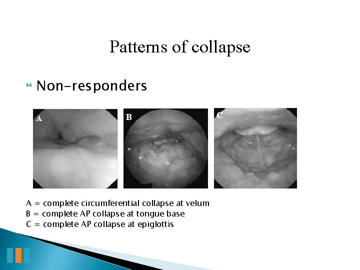 Patterns of collapse Non-responders A = complete circumferential collapse at velum B = complete