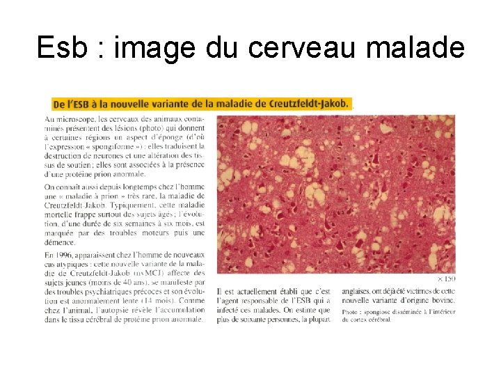 Esb : image du cerveau malade 