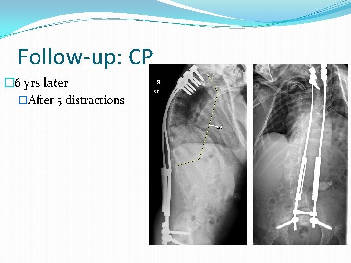 Follow-up: CP � 6 yrs later �After 5 distractions 