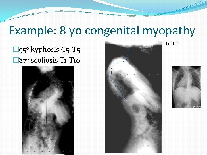 Example: 8 yo congenital myopathy � 95 o kyphosis C 5 -T 5 �