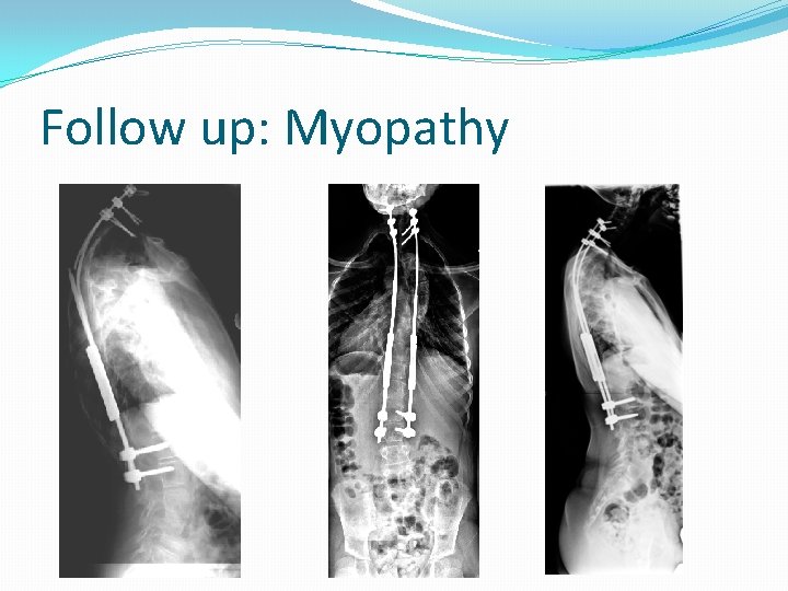 Follow up: Myopathy 