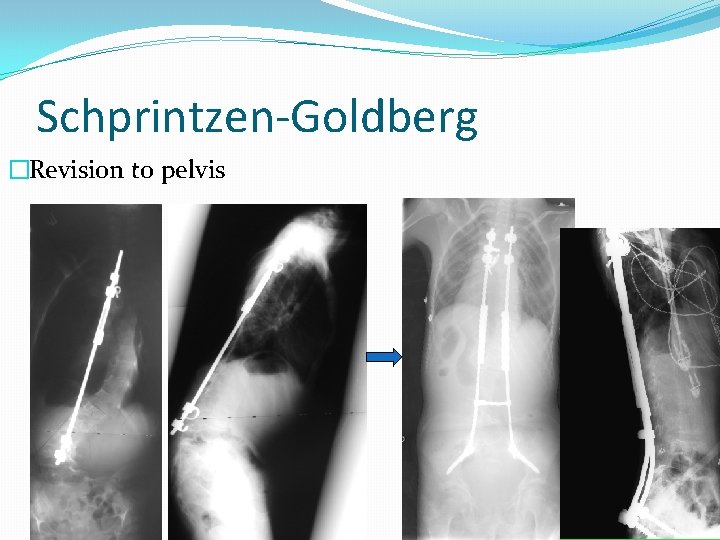 Schprintzen-Goldberg �Revision to pelvis 