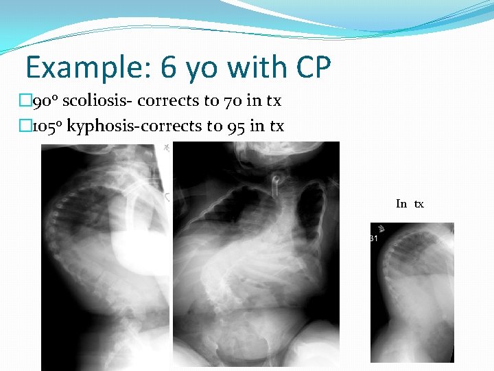 Example: 6 yo with CP � 90 o scoliosis- corrects to 70 in tx