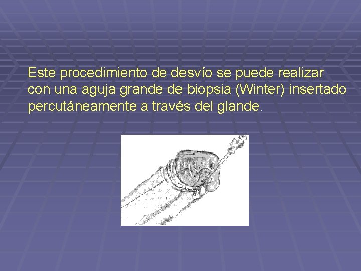 Este procedimiento de desvío se puede realizar con una aguja grande de biopsia (Winter)