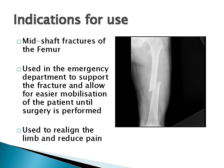 Indications for use � Mid-shaft the Femur fractures of � Used in the emergency