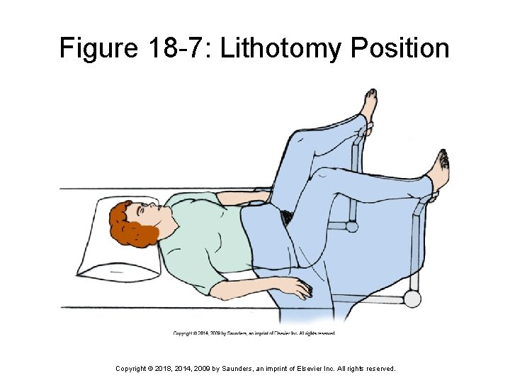Figure 18 -7: Lithotomy Position Copyright © 2018, 2014, 2009 by Saunders, an imprint