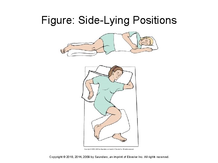 Figure: Side-Lying Positions Copyright © 2018, 2014, 2009 by Saunders, an imprint of Elsevier