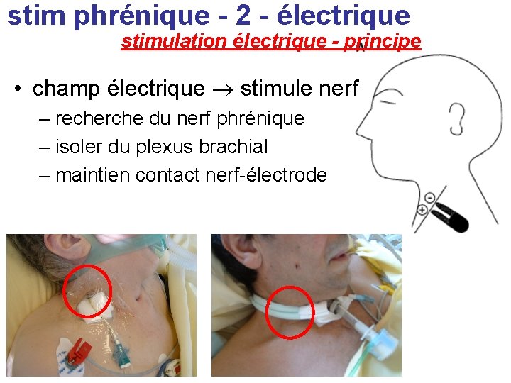stim phrénique - 2 - électrique stimulation électrique - principe • champ électrique stimule