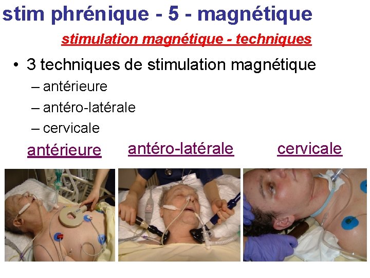 stim phrénique - 5 - magnétique stimulation magnétique - techniques • 3 techniques de