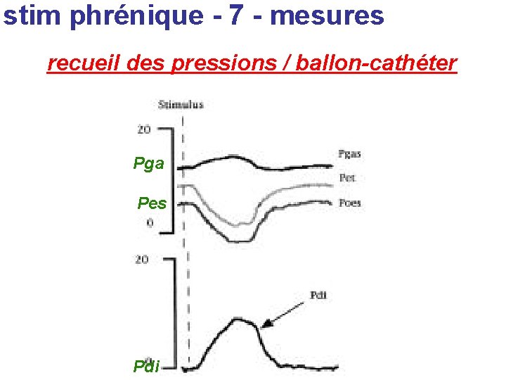 stim phrénique - 7 - mesures recueil des pressions / ballon-cathéter Pga Pes Pdi