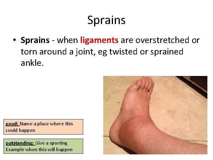 Sprains • Sprains - when ligaments are overstretched or torn around a joint, eg