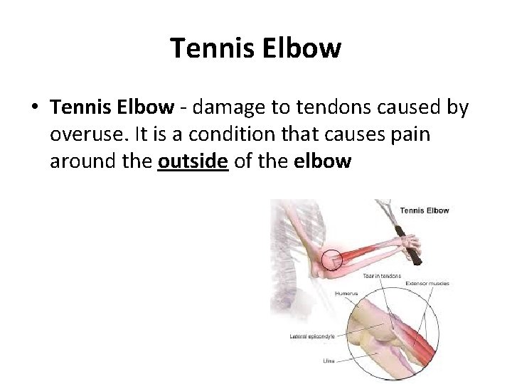 Tennis Elbow • Tennis Elbow - damage to tendons caused by overuse. It is