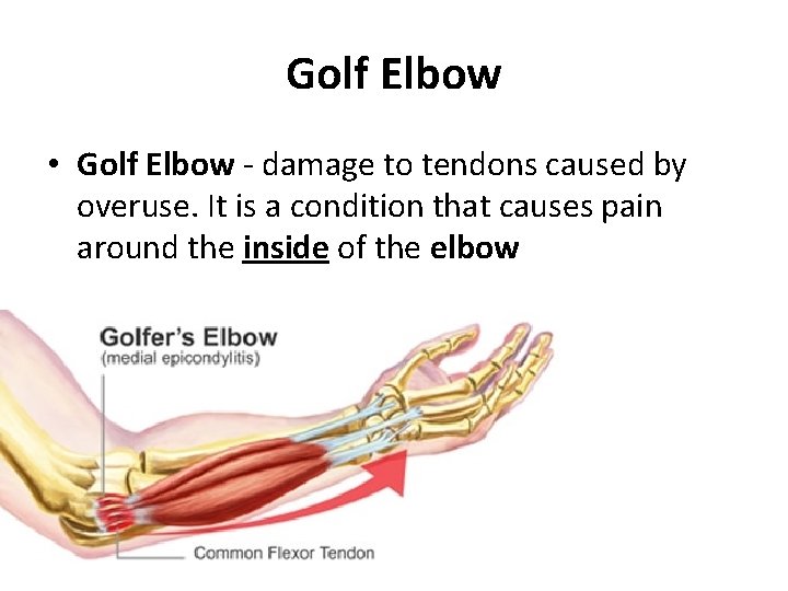 Golf Elbow • Golf Elbow - damage to tendons caused by overuse. It is