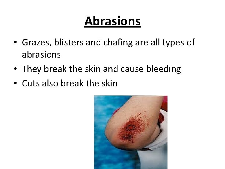 Abrasions • Grazes, blisters and chafing are all types of abrasions • They break