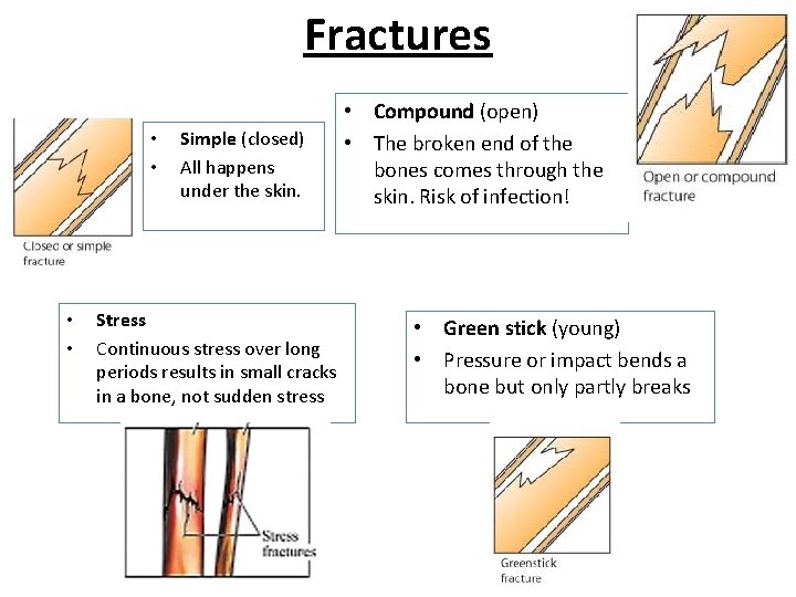Fractures • • Simple (closed) All happens under the skin. Stress Continuous stress over