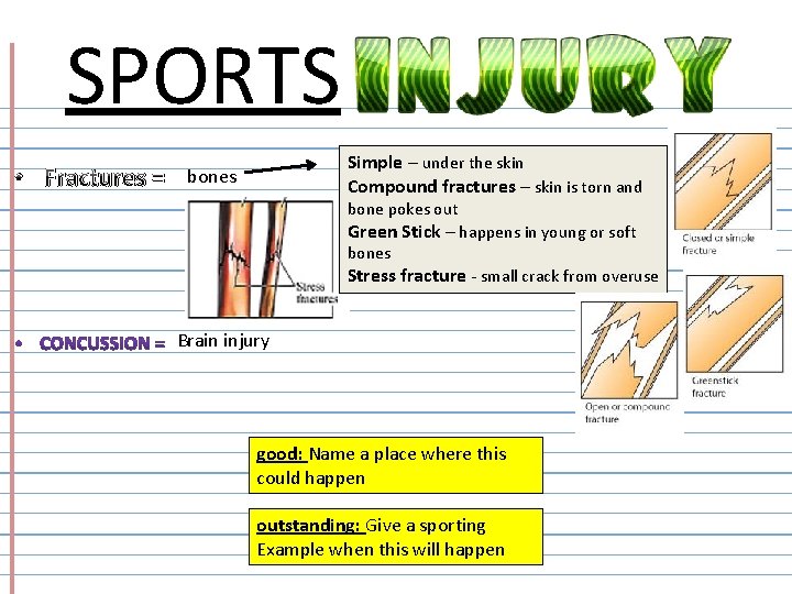 SPORTS • Fractures = Simple – under the skin Compound fractures – skin is