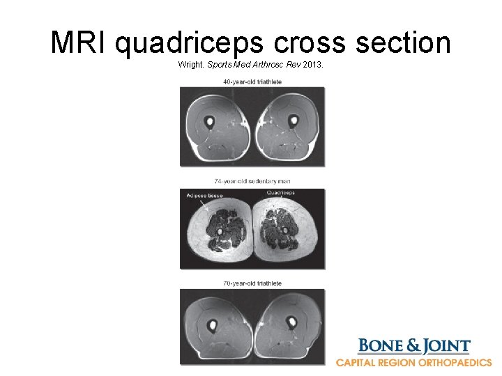 MRI quadriceps cross section Wright. Sports Med Arthrosc Rev 2013. 
