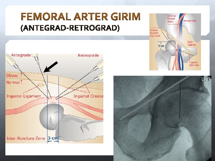 (ANTEGRAD-RETROGRAD) 