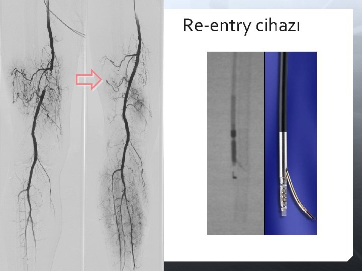 Re-entry cihazı 