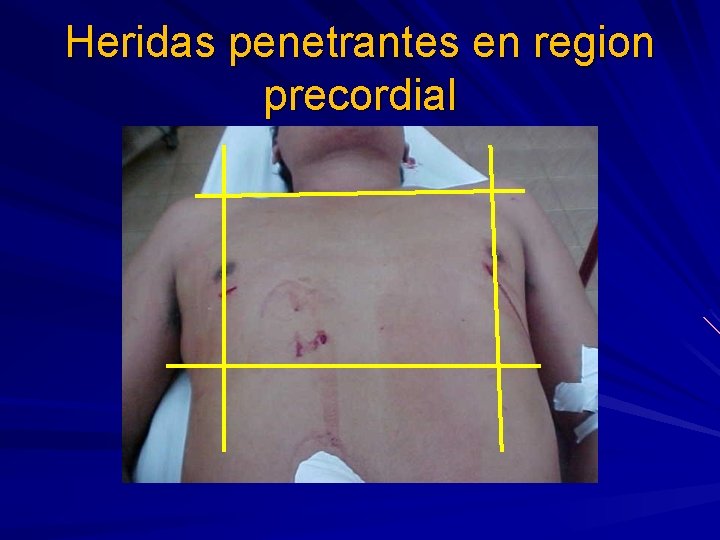 Heridas penetrantes en region precordial 