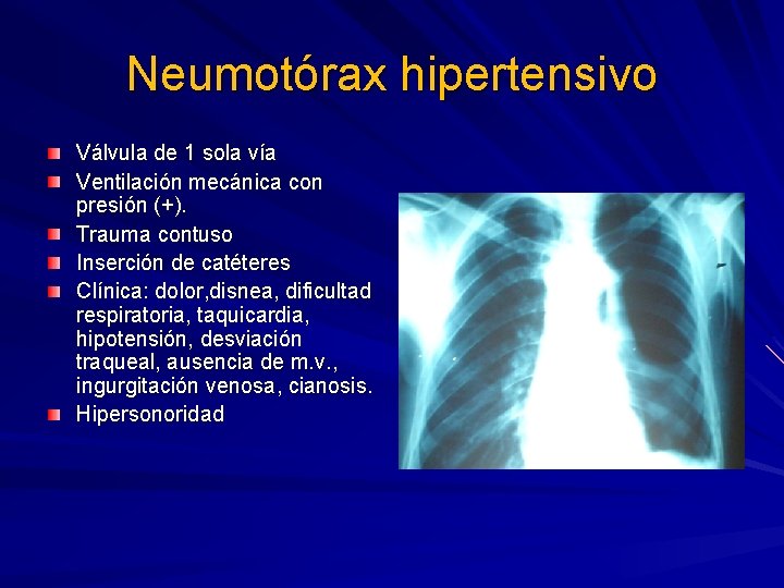 Neumotórax hipertensivo Válvula de 1 sola vía Ventilación mecánica con presión (+). Trauma contuso