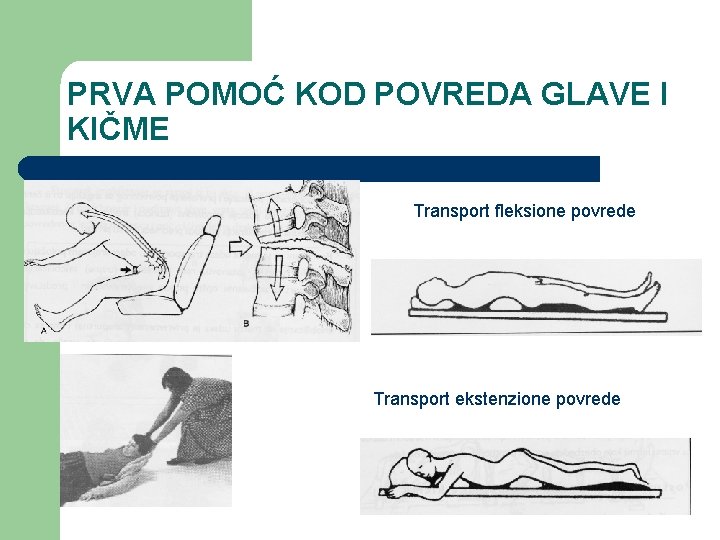 PRVA POMOĆ KOD POVREDA GLAVE I KIČME Povrede slabinske kičme Transport fleksione povrede Transport